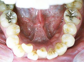 【症例6】上顎前突（出っ歯） 下顎 before
