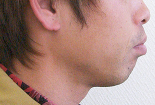 口元症例③ 右 before