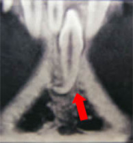 【症例17】埋伏歯（顎骨に埋まったままの歯） CT