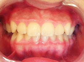 【症例18】異所萌出（上顎第二小臼歯が口蓋側に転位、捻転した叢生症例） 正面 before