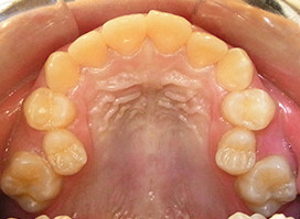 【症例18】異所萌出（上顎第二小臼歯が口蓋側に転位、捻転した叢生症例） 上顎 before