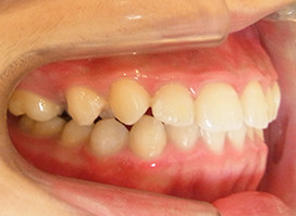 【症例18】異所萌出（上顎第二小臼歯が口蓋側に転位、捻転した叢生症例） 左 before