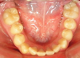 【症例18】異所萌出（上顎第二小臼歯が口蓋側に転位、捻転した叢生症例） 下顎 before