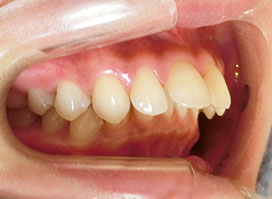 【症例8】上顎前突（出っ歯）過蓋咬合（深い咬み合わせ） 左 before