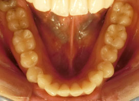 【症例8】上顎前突（出っ歯）過蓋咬合（深い咬み合わせ） 下顎 before