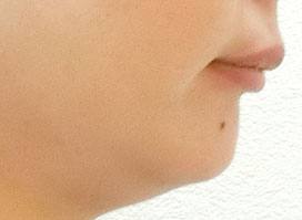 【症例8】上顎前突（出っ歯）過蓋咬合（深い咬み合わせ） 右 before
