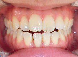 【症例26】開咬　叢生　空隙　(他院からの再治療) 正面 before