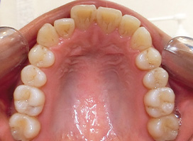 【症例26】開咬　叢生　空隙　(他院からの再治療) 上顎 before