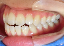 【症例26】開咬　叢生　空隙　(他院からの再治療) 右 before