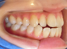 【症例26】開咬　叢生　空隙　(他院からの再治療) 左 before