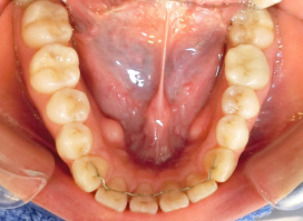 【症例26】開咬　叢生　空隙　(他院からの再治療) 下顎 before