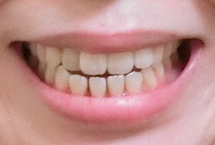 【症例26】開咬　叢生　空隙　(他院からの再治療) 正面 before