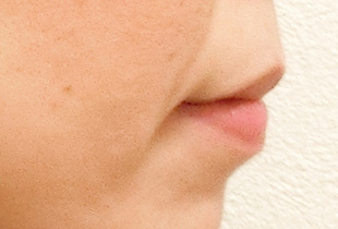 【症例26】開咬　叢生　空隙　(他院からの再治療) 右 before