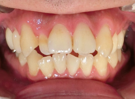 【症例10】上顎前突（出っ歯）　開咬　叢生 正面 before