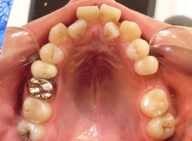 【症例10】上顎前突（出っ歯）　開咬　叢生 上顎 before