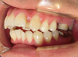 【症例10】上顎前突（出っ歯）　開咬　叢生 右 before