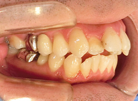 【症例10】上顎前突（出っ歯）　開咬　叢生 左 before