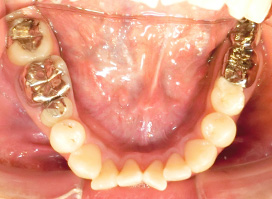 【症例10】上顎前突（出っ歯）　開咬　叢生 下顎 before