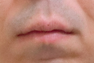 【症例10】上顎前突（出っ歯）　開咬　叢生 正面 before