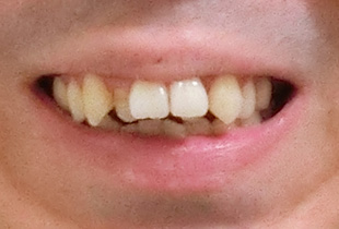 【症例10】上顎前突（出っ歯）　開咬　叢生 正面 before