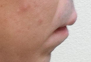 【症例10】上顎前突（出っ歯）　開咬　叢生 右 before