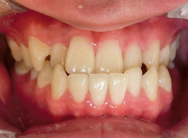 【症例25】インプラントと矯正の併用③（反対咬合(受け口)　叢生　左下第二小臼歯先天欠如） 正面 before