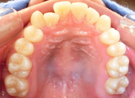 【症例25】インプラントと矯正の併用③（反対咬合(受け口)　叢生　左下第二小臼歯先天欠如） 上顎 before