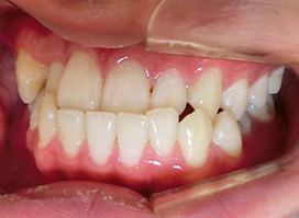 【症例25】インプラントと矯正の併用③（反対咬合(受け口)　叢生　左下第二小臼歯先天欠如） 右 before
