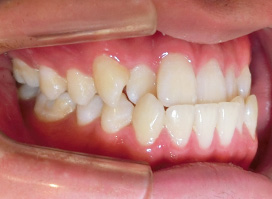 【症例25】インプラントと矯正の併用③（反対咬合(受け口)　叢生　左下第二小臼歯先天欠如） 左 before