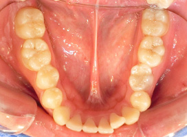 【症例25】インプラントと矯正の併用③（反対咬合(受け口)　叢生　左下第二小臼歯先天欠如） 下顎 before