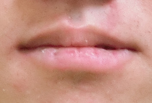 【症例25】インプラントと矯正の併用③（反対咬合(受け口)　叢生　左下第二小臼歯先天欠如） 正面 before