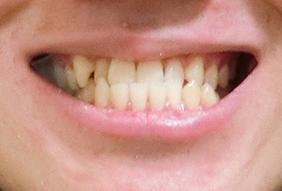 【症例25】インプラントと矯正の併用③（反対咬合(受け口)　叢生　左下第二小臼歯先天欠如） 正面 before