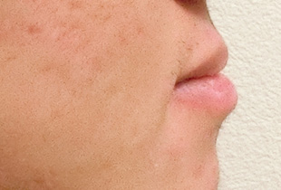 【症例25】インプラントと矯正の併用③（反対咬合(受け口)　叢生　左下第二小臼歯先天欠如） 右 before