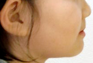【症例5】小児 反対咬合（受け口） 非抜歯 横顔・左 before