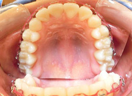 【症例5】小児 反対咬合（受け口） 非抜歯 上顎 治療中