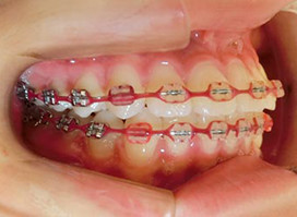【症例5】小児 反対咬合（受け口） 非抜歯 左 治療中