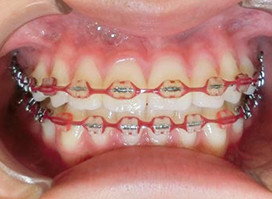 【症例5】小児 反対咬合（受け口） 非抜歯 正面 治療中