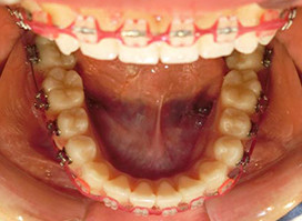 【症例5】小児 反対咬合（受け口） 非抜歯 下顎 治療中